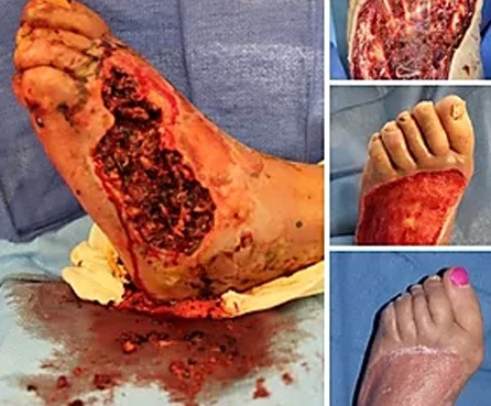 Foot-ulcer-wound-image-3