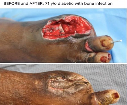 Foot-ulcer-wound-image-2