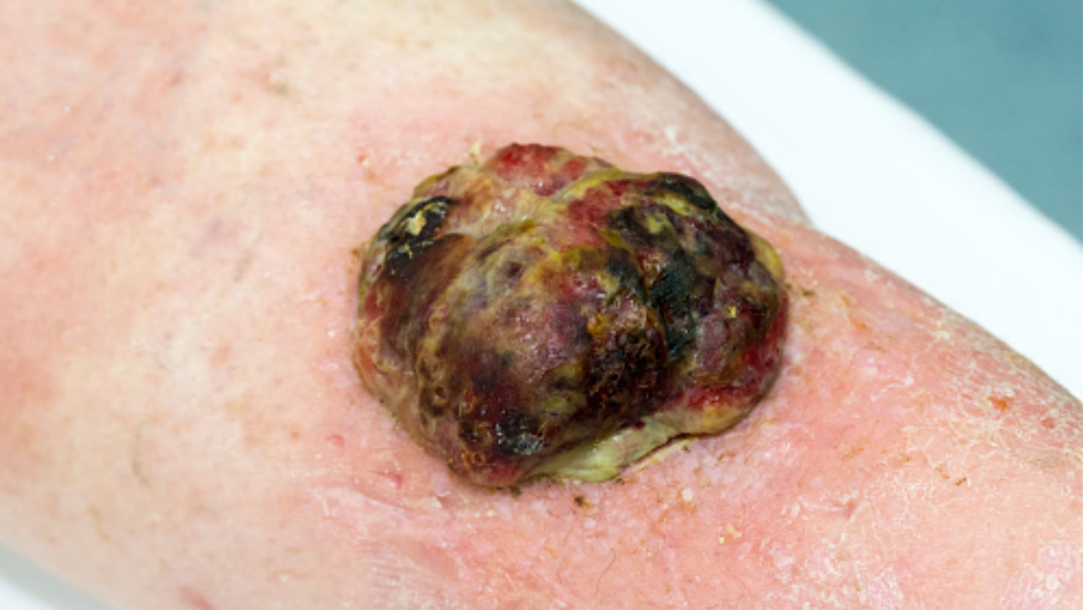 What Are Fungating Tumors? - Wound Institute of America