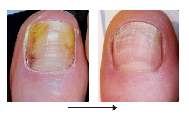 Toenail Fungus Example